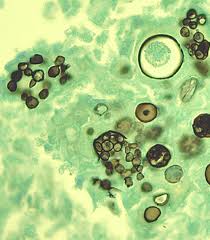 Fifth Valley Fever death in SLO County this year
