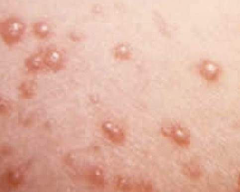 Cal Poly warns campus community, student diagnosed with chickenpox
